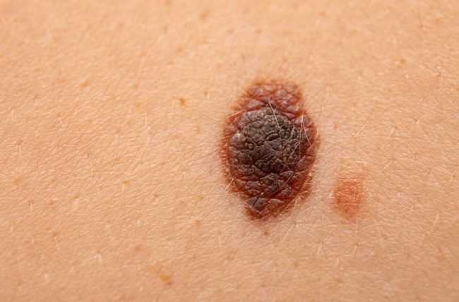 Skin Cancer Prediction